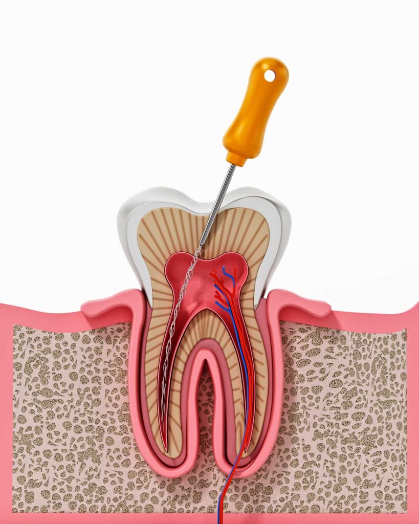 endodoncia en Puertollano, tratamiento de conductos en Puertollano.
