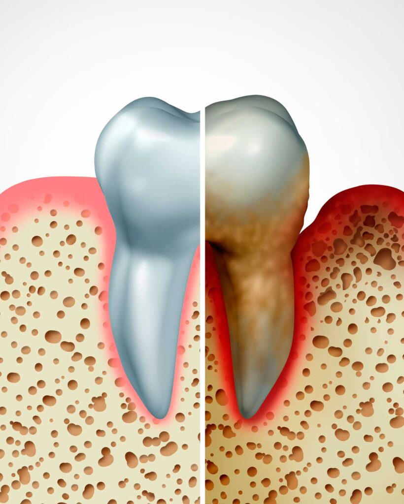 periodoncia en Puertollano, tratamiento para las encías en Puertollano.